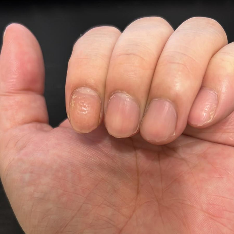 如何識別和治療指甲凹陷